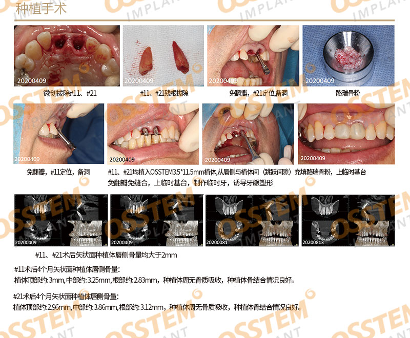 【白银奖病例】上前牙即刻种植修复-Dr_02.jpg