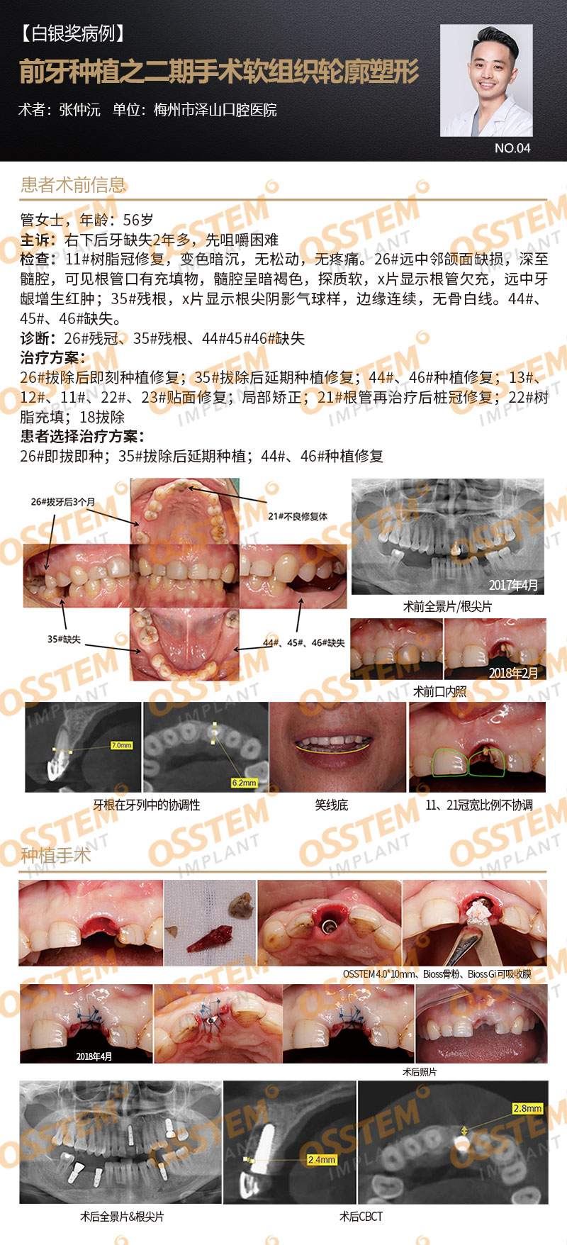 【白银奖病例】前牙种植之二期手术软组织轮廓塑形-Dr_01.jpg