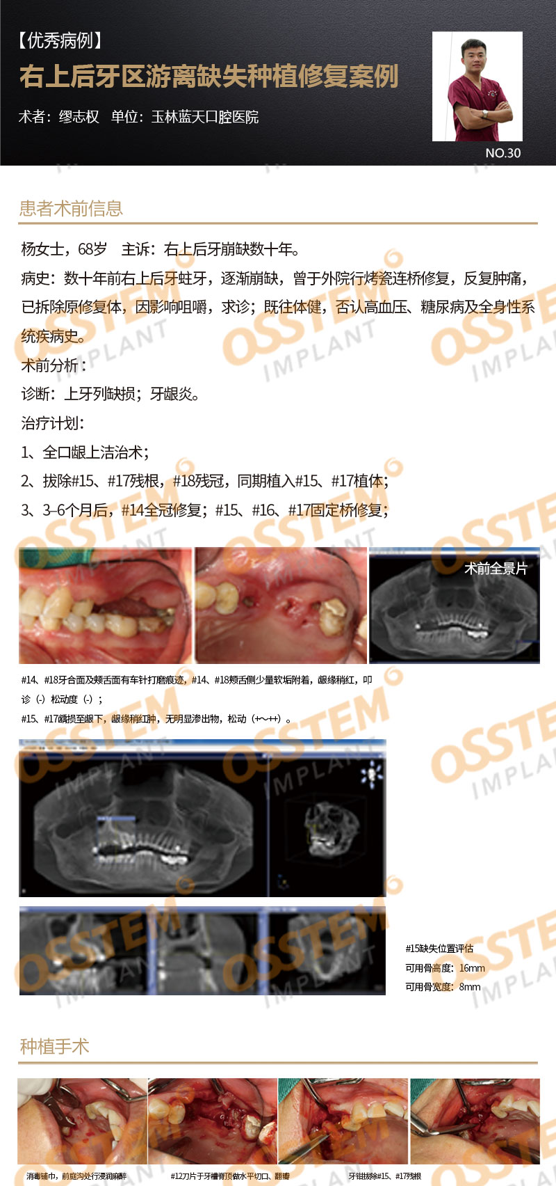 【优秀病例】右上后牙区游离缺失种植修复案例-Dr_01.jpg