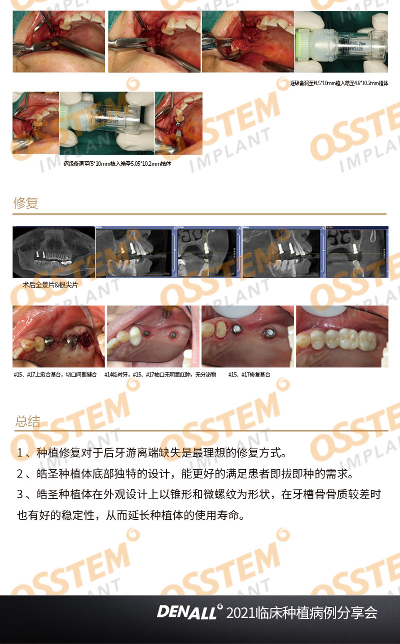 【优秀病例】右上后牙区游离缺失种植修复案例-Dr_02.jpg
