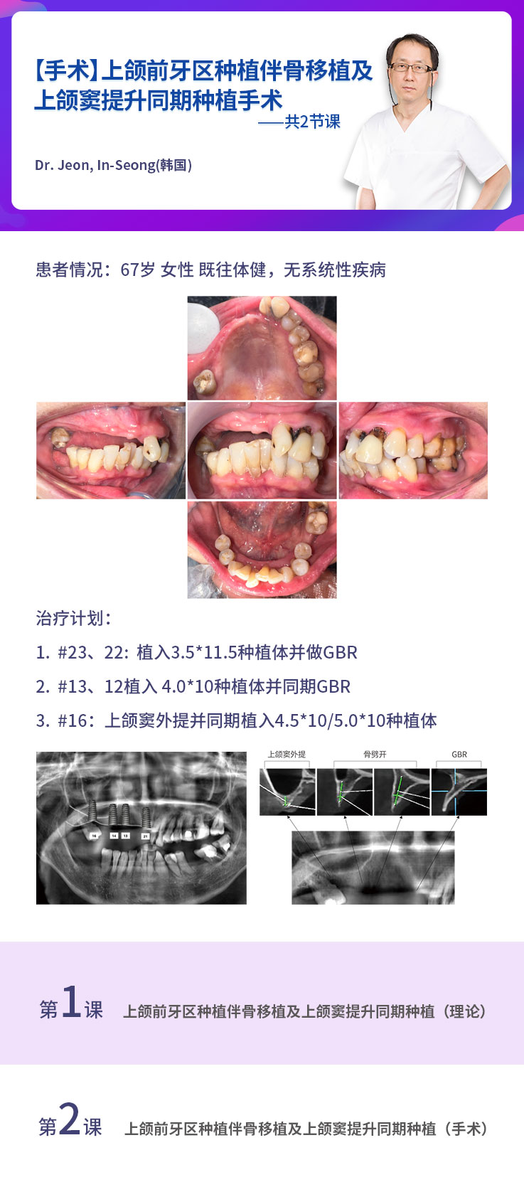 【4】【B56】上颌前牙区种植伴骨移植及上颌窦提升同期种植手术-在线课程导图.jpg