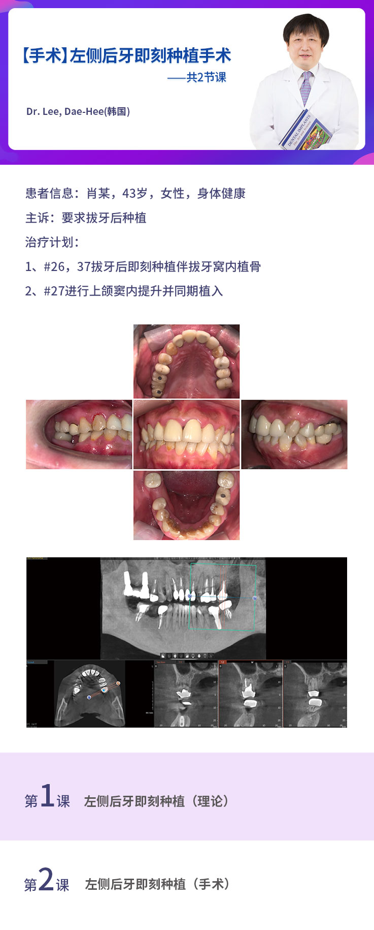 【5】【B57】【手术】左侧后牙即刻种植手术-Dr.jpg