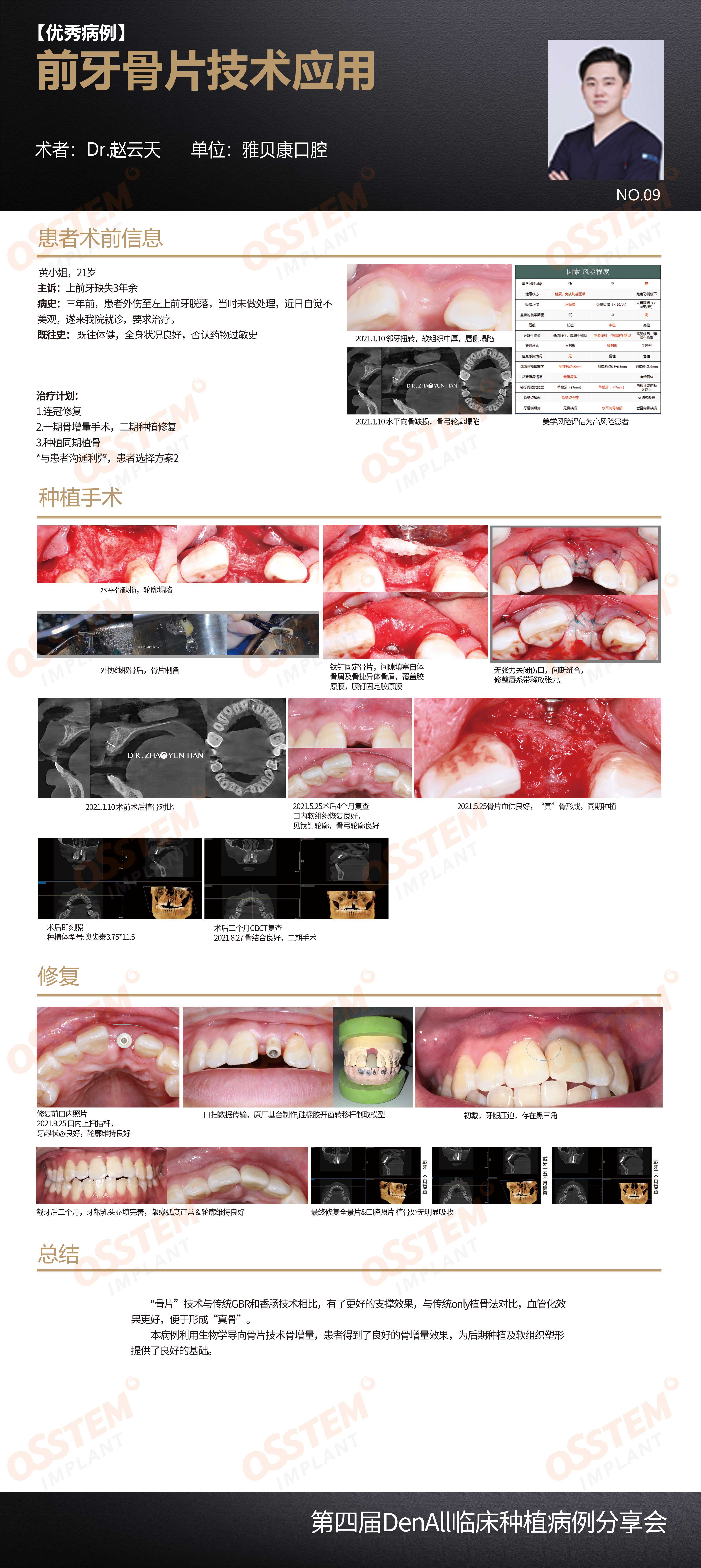 9-前牙骨片技术应用-赵云天.jpg