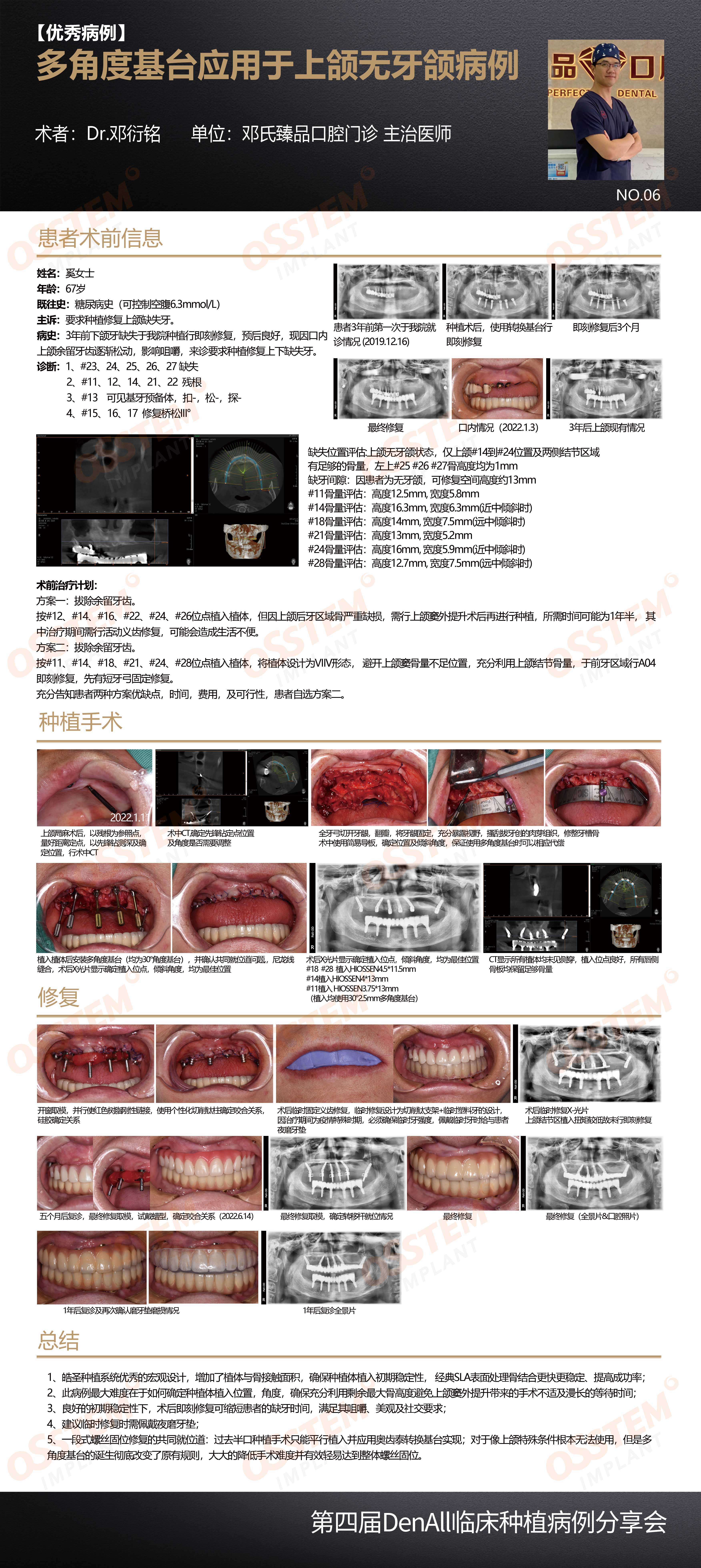 6-多角度基台应用于上颌无牙颌病例-邓衍铭.jpg