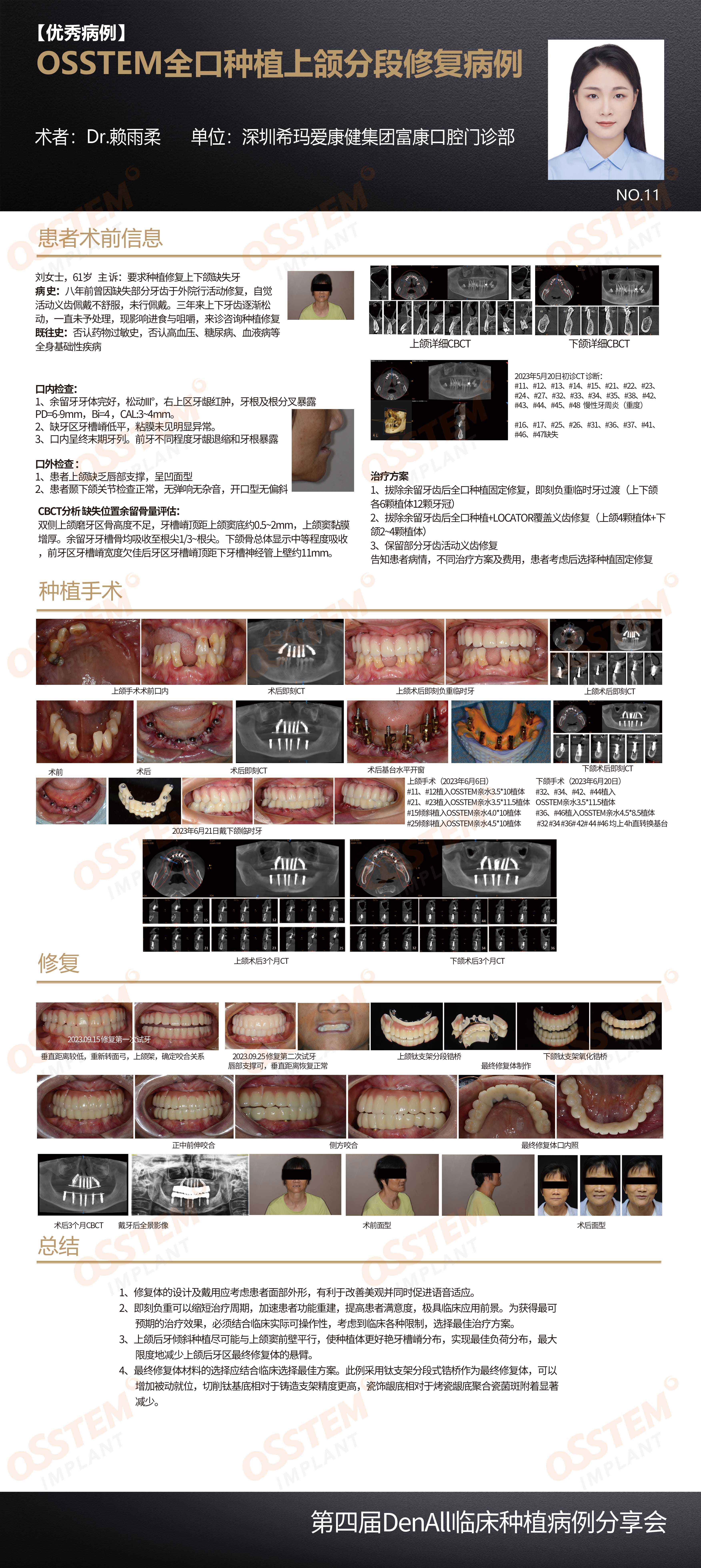 11-OSSTEM全口种植上颌分段修复病例-赖雨柔.jpg