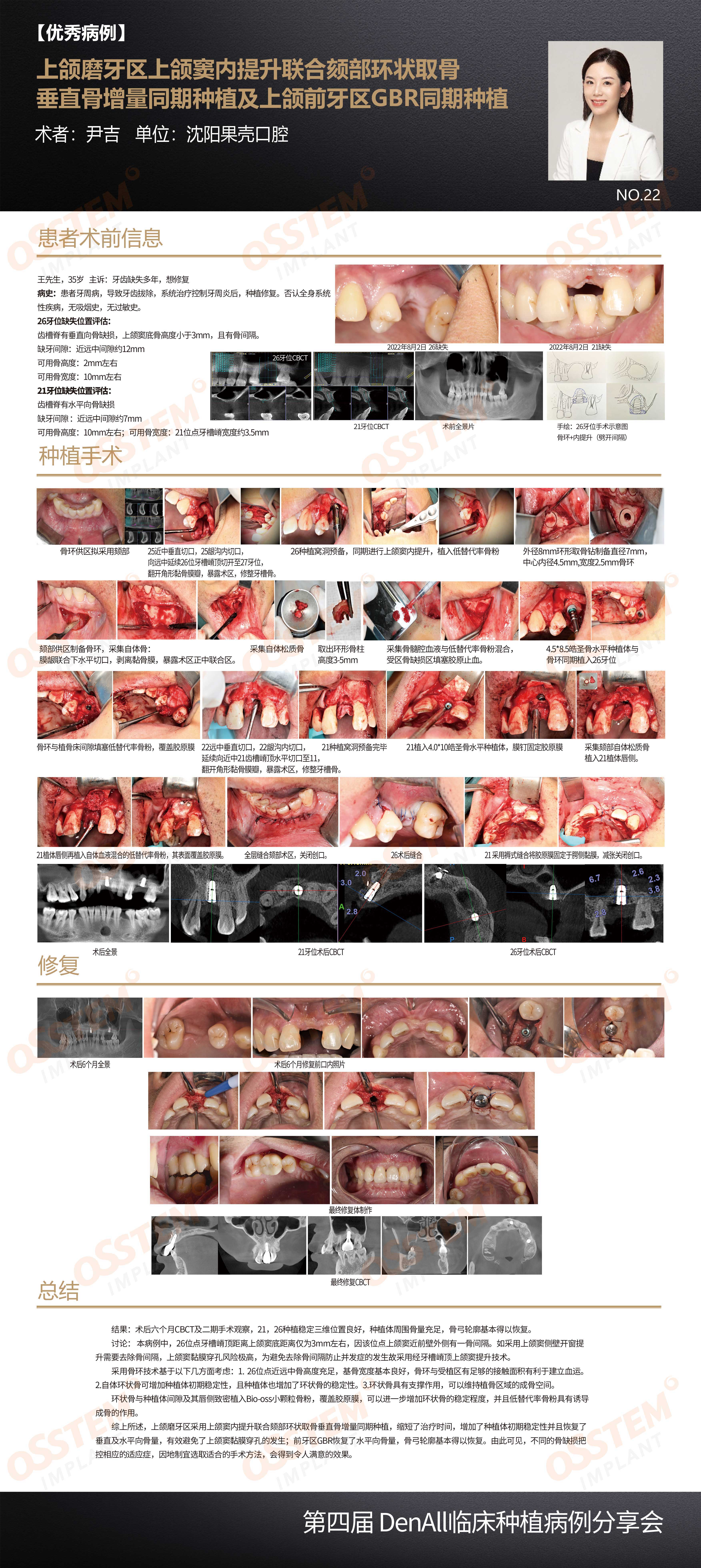 22-上颌磨牙区上颌窦内提升联合颏部环状取骨垂直骨增量同期种植及上颌前牙区GBR同期种植.jpg